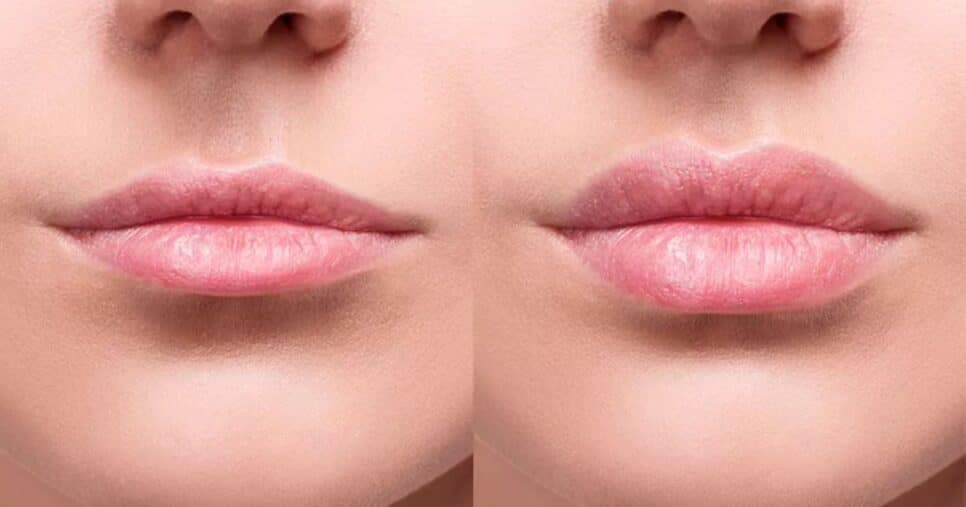 Receita natural com 2 ingredientes deixa lábios super volumosos (Reprodução/Dream Plastic/Canva)