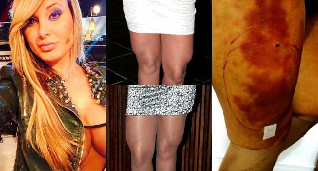 Cirurgião diz que não sabia se Andressa Urach iria sobreviver