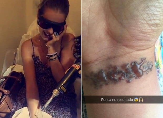 Yasmin Brunet  remover tatuagem em sessões de laser