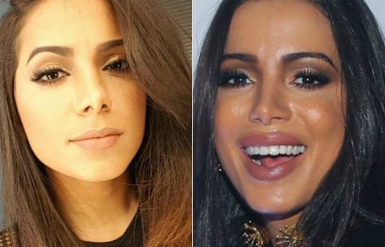 Após polêmica, Anitta admite: "Faço preenchimento há muito tempo"