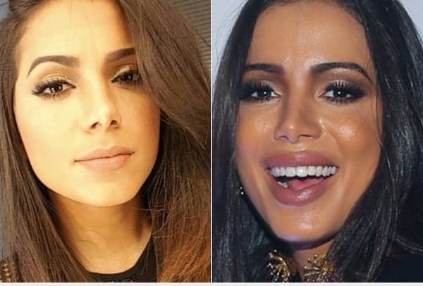 Anitta se arrepende de cirurgia e, de madrugada, pede ajuda em clínica