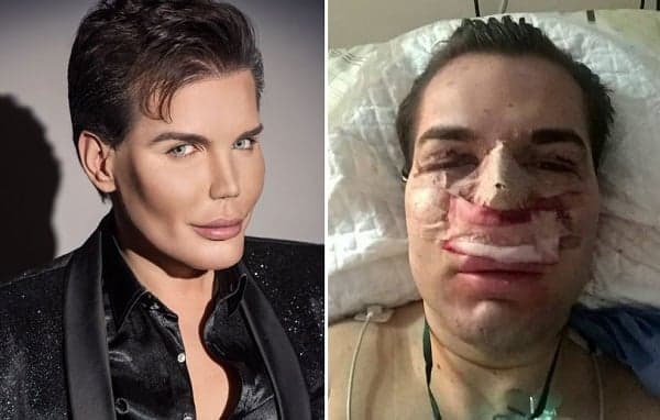 Ken Humano brasileiro contrai bactéria comedora de carne