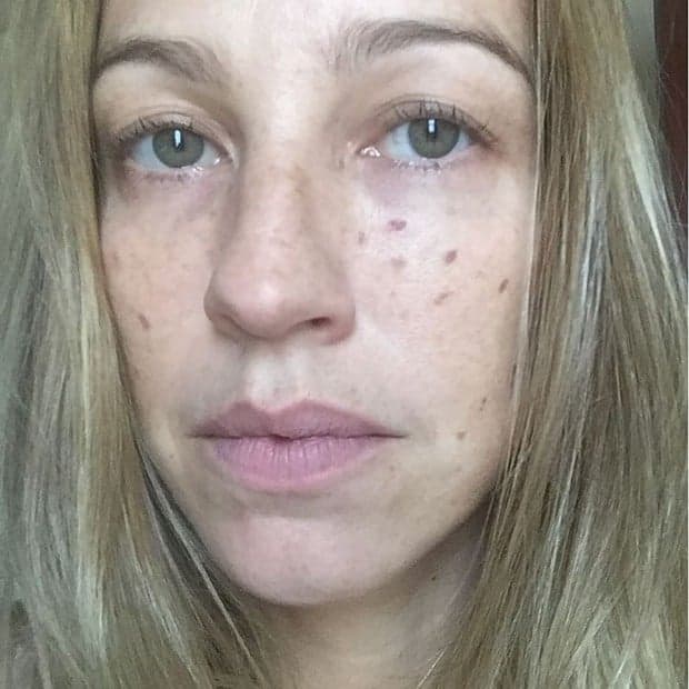 Luana Piovani publica foto com rosto cheio de marcas; entenda