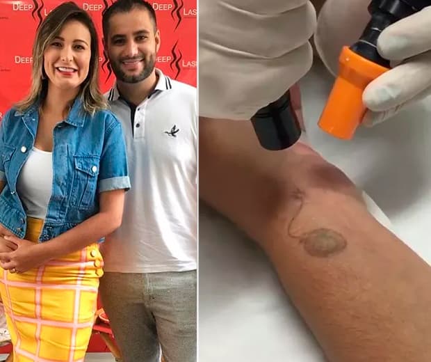 Andressa Urach admite que se arrepende de tattoos e "sofre" para removê-las