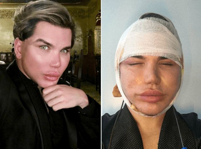 Ken Humano brasileiro enfrenta 50ª cirurgia e lamenta: "Foi a pior"