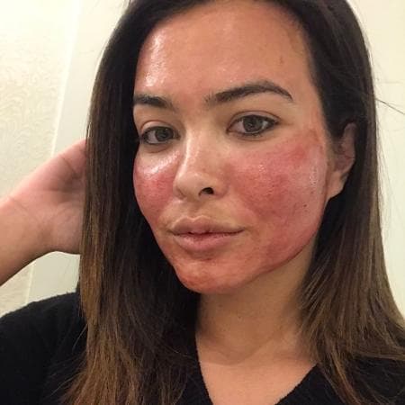 Geisy Arruda faz procedimento estranho e passa o próprio sangue no rosto