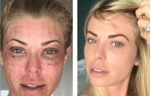 Modelo e repórter, Carol Bittencourt, mostra o antes e depois de tratamento