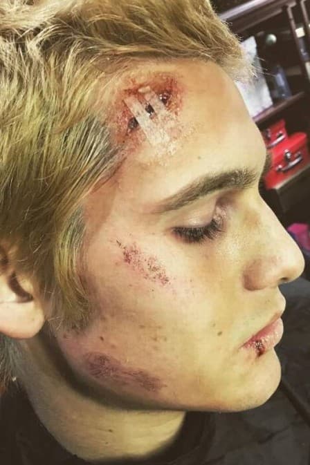 Nicolas Prattes aparece com o rosto "arrebentado" e assusta fãs