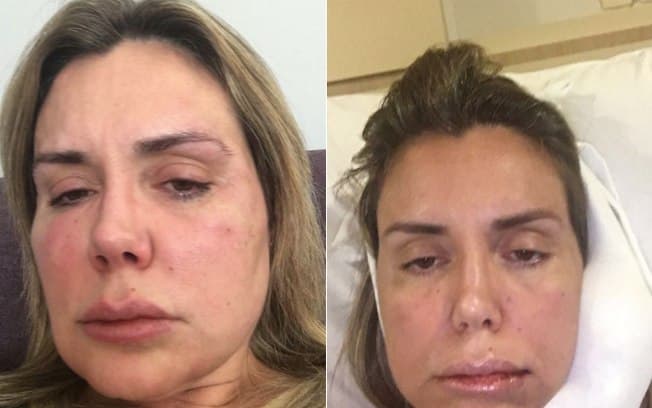 Renata Banhara abre o jogo e revela que já perdeu as contas de quantas cirurgias fez por conta de bactéria