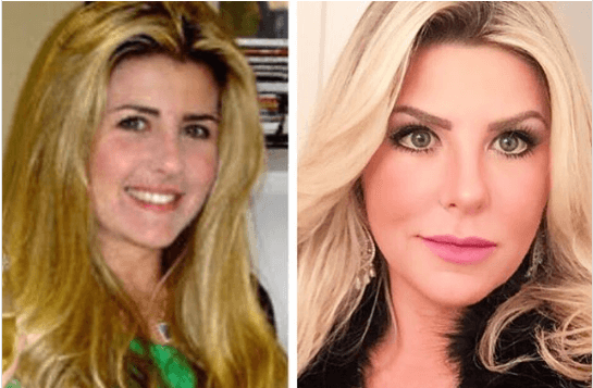Ex-BBB compara antes e depois e critica seguidores: "Plastificada é sua vó"