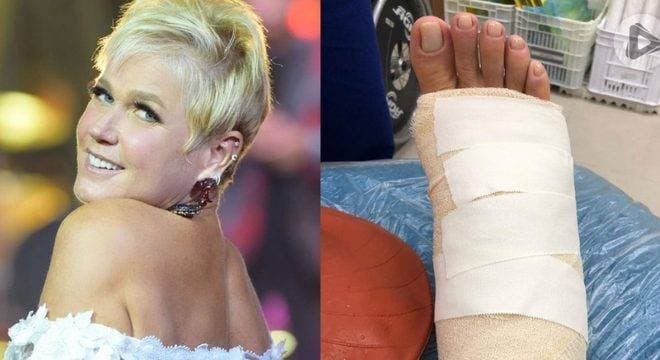 Xuxa mostra pé quebrado e revela atual estado de saúde: "vai ficar bom"