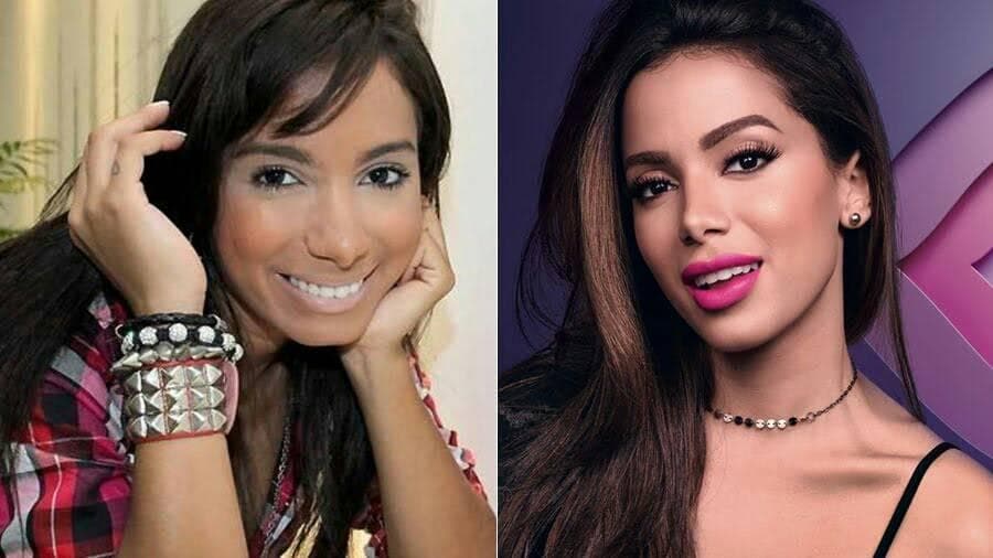Anitta surpreende e abre o jogo sobre novas cirurgias plásticas: "Por que não?"