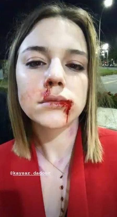 Alice Wegmann aparece com o rosto deformado e explica o que ocorreu: 'Estava torcendo para acontecer logo'