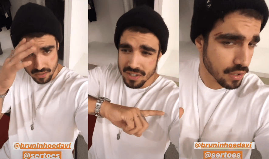 Caio Castro aparece com cortes no rosto e explica o que aconteceu: 'Eu não briguei'