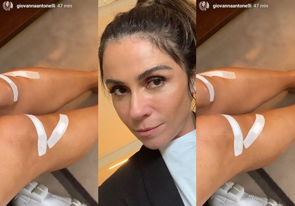 Giovanna Antonelli aparece com pernas machucadas e revela o que aconteceu