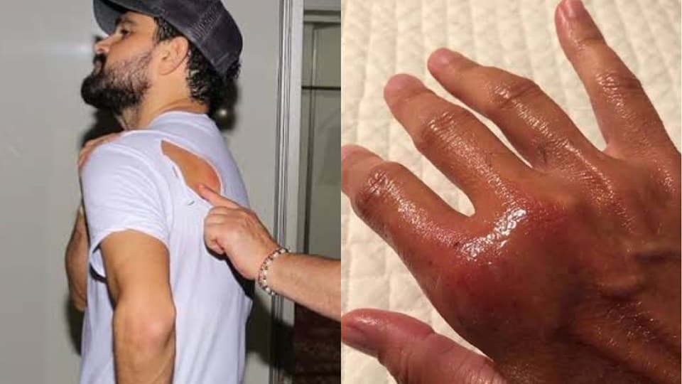 Luciano Camargo e Daniela Escobar são atacados por animais, imagens fortes são divulgadas e amputação é cogitada