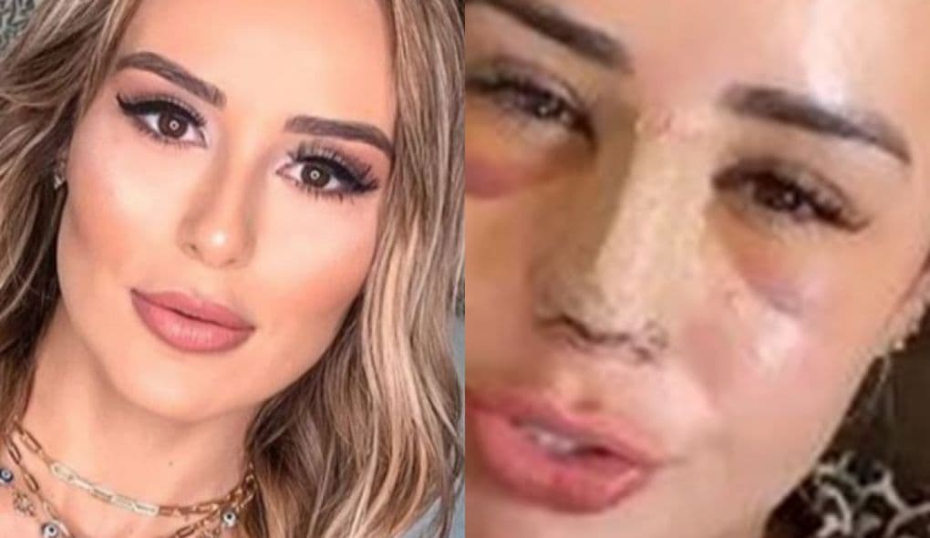 Ex-BBB Letícia Santiago aparece com rosto todo inchado e olhos roxo e deixa todos preocupados
