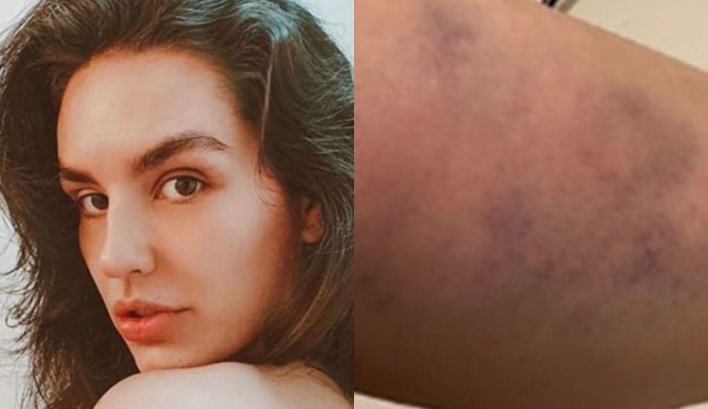 Kéfera corta a bunda e fica com hematomas na perna após sofrer acidente em sua própria festa