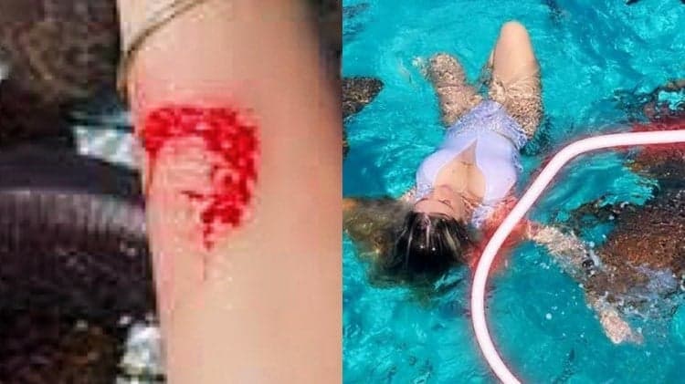Após ataque de tubarão, famosa mostra como ficou o braço brutalmente mordido: "Achei que fosse morrer"
