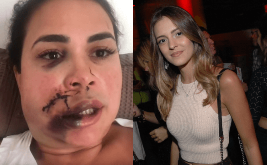 Influencer é brutalmente agredida, acusa modelo e comove famosos após rosto desfigurado: "Demônio"