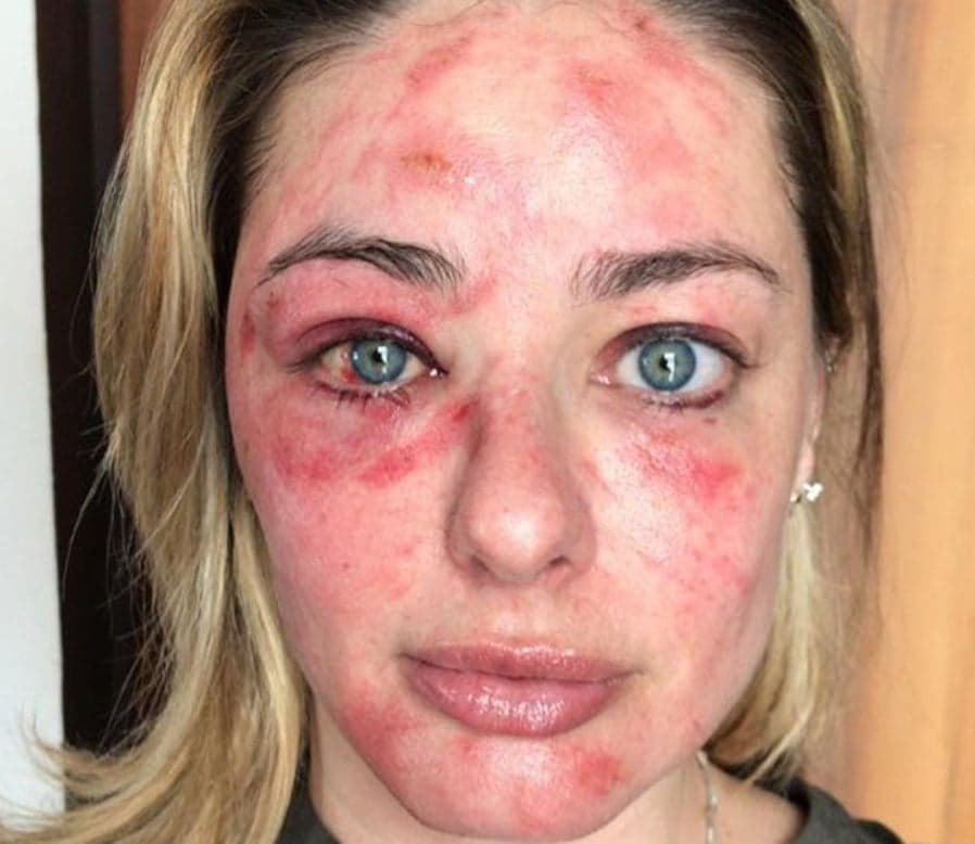 Campeã do MasterChef sofre grave acidente e fica com rosto totalmente desfigurado