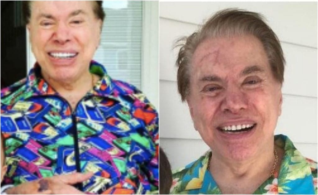 Aos 89 anos, Silvio Santos está irreconhecível e manchas roxas pelo corpo chocam a todos: "Que isso?"