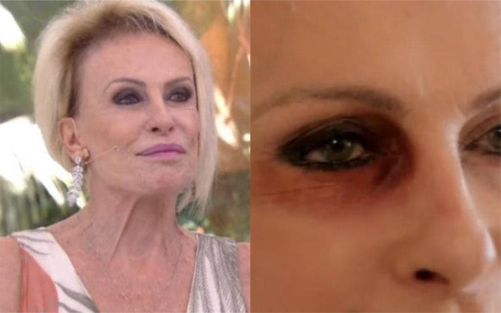 Enfrentando grave doença, Ana Maria Braga surge com olho roxo e não esconde: "Violência doméstica"