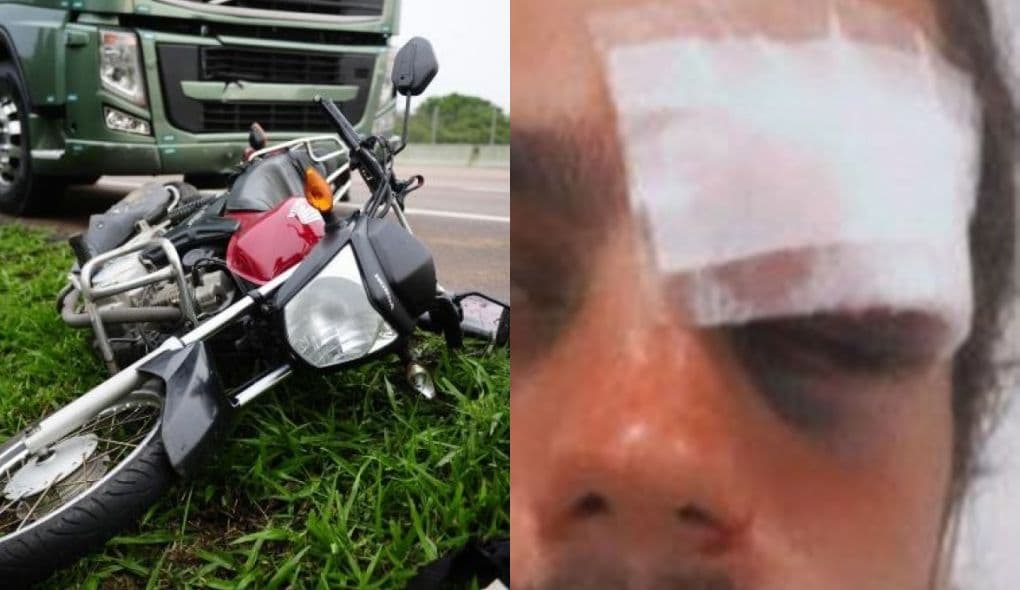 Ex-participante de reality show sofre acidente de moto e fica com rosto deformado