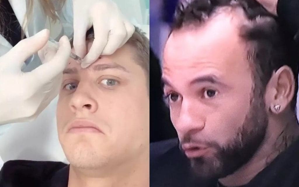 Implante capilar, botox e harmonização facial; a grande mudança dos participantes do BBB20 após o programa