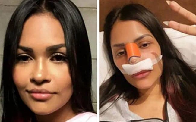 Flayslane, do BBB20, é obrigada a realizar cirurgia e aparece com curativos no rosto: "Carnezinha esponjosa"