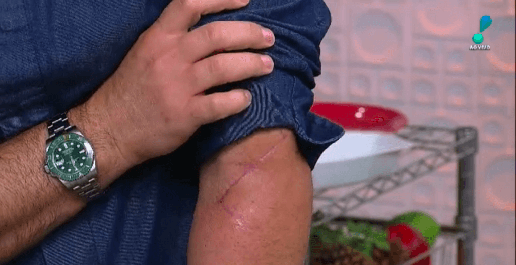 Edu Guedes acabou expondo cicatriz após acidente (Foto montagem) 