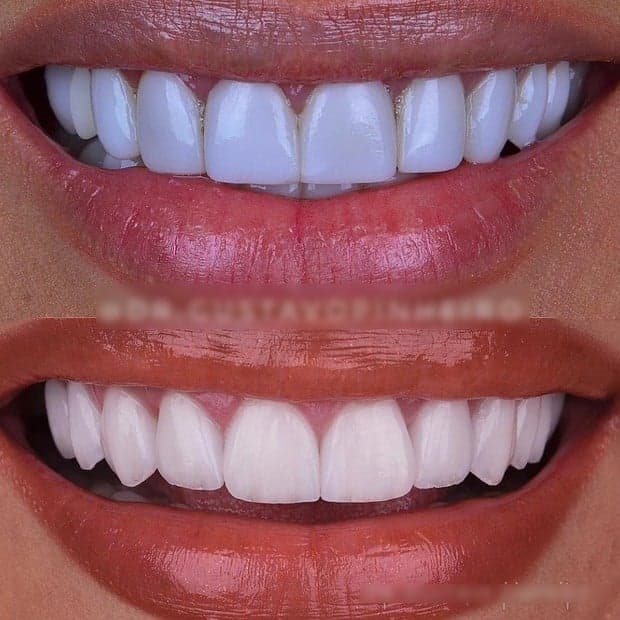 O antes e depois dos dentes de Simaria O antes e depois dos dentes de Simaria