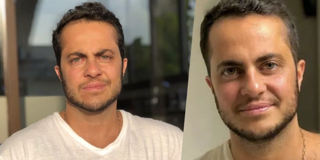 Thammy Miranda causa pânico ao aparecer com olho roxo e desabafo é feito a milhões: "Todo machucado"