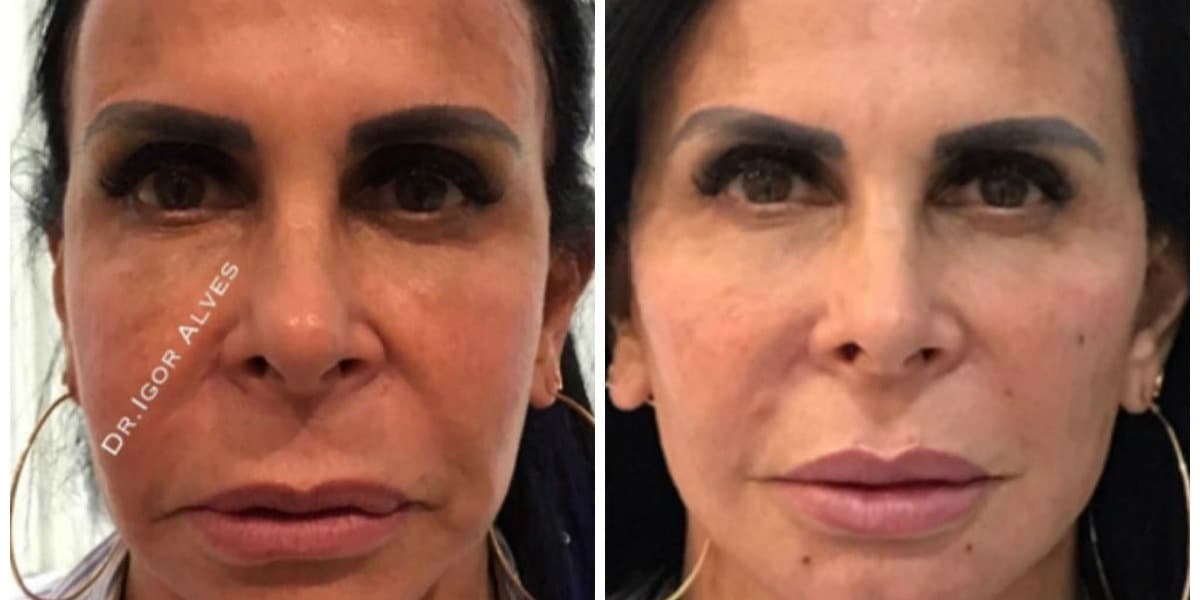 Gretchen antes e depois do processo (Foto: Reprodução) Gretchen antes e depois do processo (Foto: Reprodução)