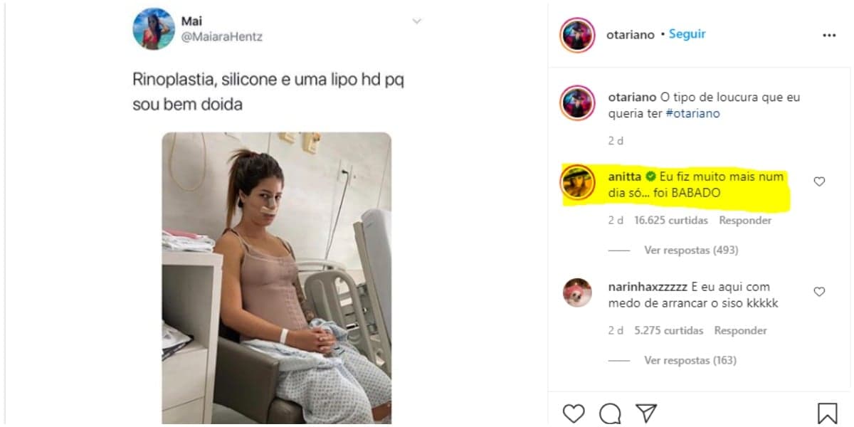 Anitta fala que fez mais de 3 plásticas em um só dia (Foto: Reprodução) Anitta fala que fez mais de 3 plásticas em um só dia (Foto: Reprodução)