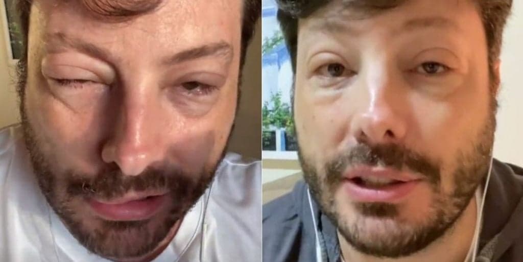 Rosto desfigurado de Danilo Gentili após choque anafilático, gera terror e apresentador quase morre