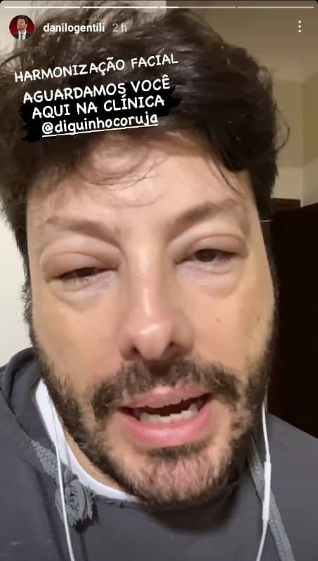 Danilo Gentili ficou com o rosto deformado (Foto: Reprodução/ Instagram)