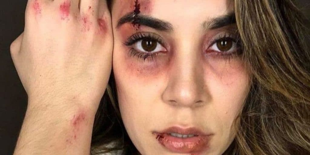 Naiara Azevedo surge com o rosto completamente deformado, expõe roxos e confirma séria agressão: "Muita dor"