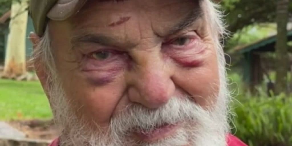 “É definitivo”, Globo dá notícia envolvendo Lima Duarte, aos 91 anos, após acidente inesperado e rosto desfigurado