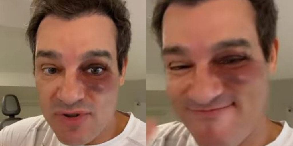 Celso Portiolli surge com o olho estourado, admite fuga com mulheres e expõe atitude de esposa: "Apanhar"
