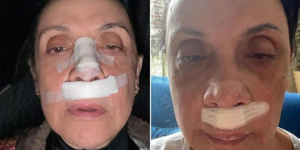 Grande estrela da Globo se machuca gravemente, quebra nariz e expõe horror: 'Nariz está torto, mas a vida preservada'