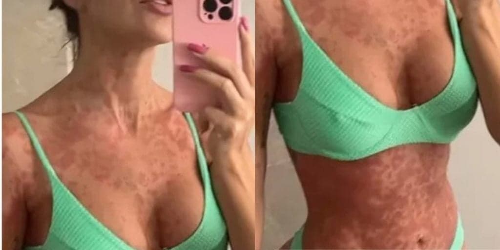 Ex-BBB sofre com doença misteriosa, mal se espalha pelo corpo inteiro e ela lamenta situação: "Queimando"