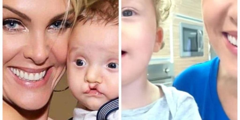 Ana Hickmann mostra antes e depois surpreendente de sobrinho que nasceu com lábio leporino: "Lindo"