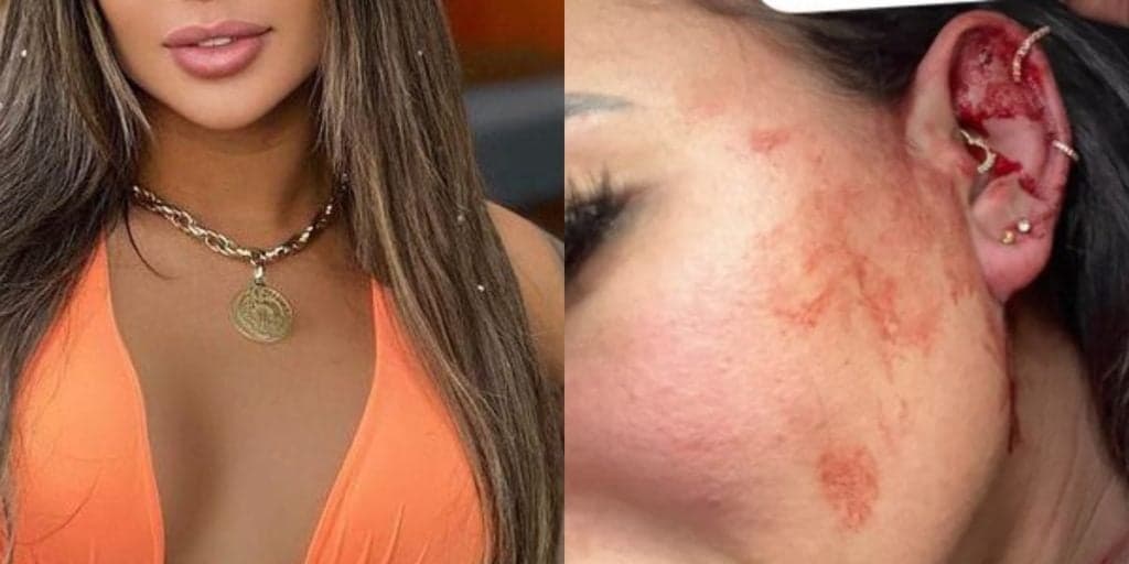 Famosa é espancada pelo namorado, mostra fotos agonizantes de machucados e denuncia: "Me destruindo"