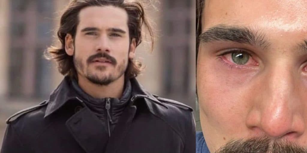 Nicolas Prattes surge com olhos inchados em gravações