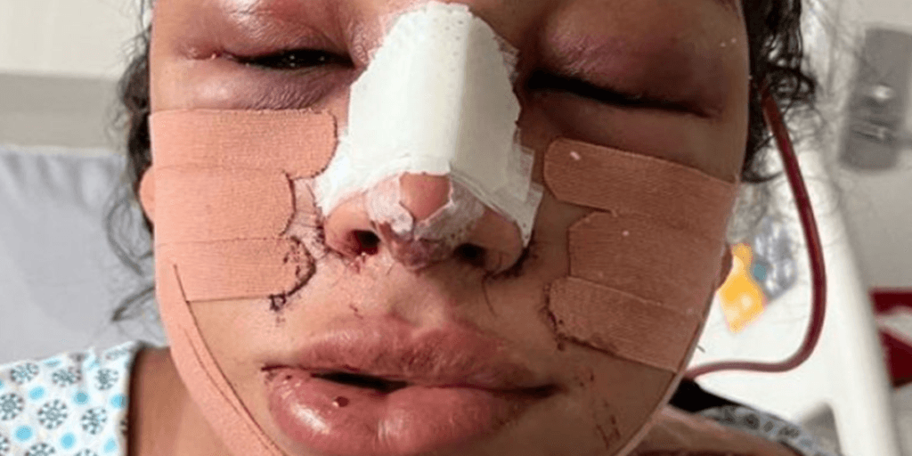 Linn da Quebrada aparece com rosto inchado após procedimento de feminilização