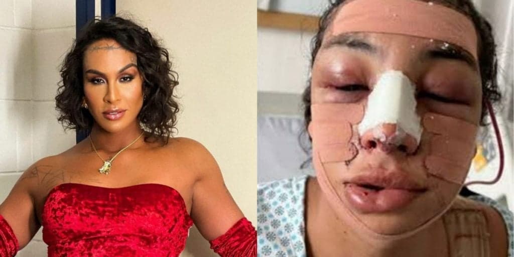 Lina faz cirurgia de feminilização e mostra resultado: "Biologicamente travesti"