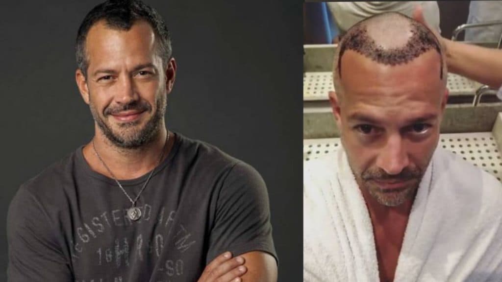 Malvino Salvador faz procedimento, coloca cabelo e imagens com o resultado são de cair o queixo