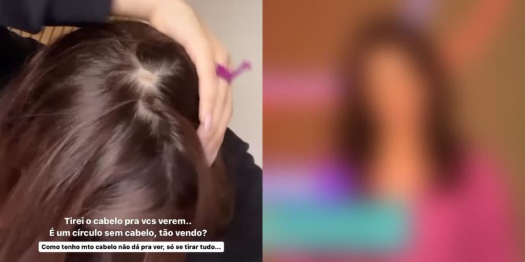 Ex-BBB revela ter alopecia, choca público com imagens e diz que começará tratamento: "Muito louco"