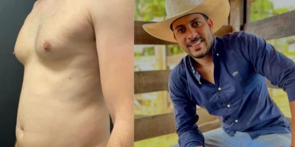 Caio Afiune do BBB21 faz lipo lad em barriga levemente avantajada e resultado é surpreendente; fotos